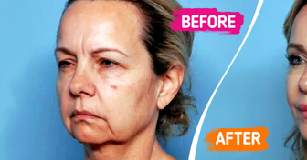 15 People Who Chose Plastic Surgery and Are Totally Obsessed with Their New Looks