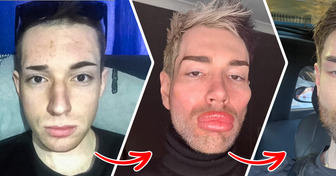 A Man Removed 13 Ml of Facial Fillers, Leaving Everyone Thrilled With His New Look