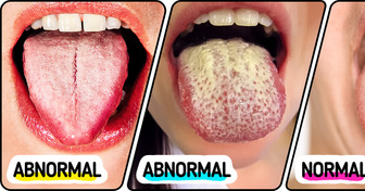 8 Effective Ways to Restore a Healthy, Pink Tongue