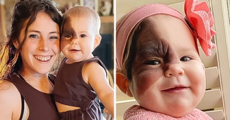 Baby Was Born With a Rare Mark on Her Face and Her Mom Insists on Showing Her How Unique She Is