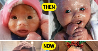 Baby’s Unusual Appearance Shocked the Delivery Room, But See How Gorgeous She Looks Today