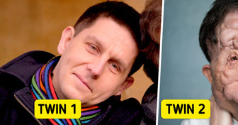 “No One Believes We’re Twins!” Rare Disorder Completely Reshaped This Man’s Face