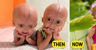 Meet The Benjamin Button Twins Who Captured People’s Hearts