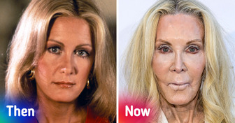 13 Celebrities Who Are Barely Recognizable After Cosmetic Procedures