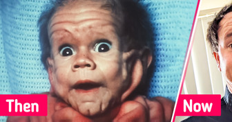 A Baby Was Born with a Rare Skin Condition That Baffled Doctors 20 Years Ago Overcame Enormous Odds to Live