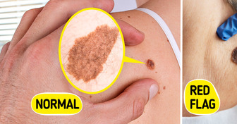 5 Alarming Signs Your Moles Could Be Deadly Skin Cancer