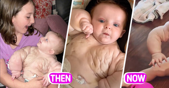 Meet “Baby Hulk,” the Newborn Girl Who Survived Against All Odds to Amaze Doctors