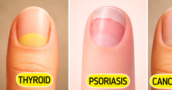 These Nail Changes May Be Early Signs of Serious Diseases