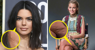 18 Celebrities Who Proudly Display What Many Would Consider Flaws
