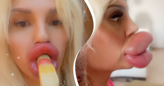 “I’m More Lips Than Human”, A Woman Struggles to Eat Due to Her Huge Lips but is Determined to Make Them Even Bigger