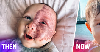 Mom Who Faced Harsh Criticism for Lasering Her Baby’s Large Birthmark Reveals Her Reasons