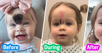 “People Would Stare at Her”, Parents Sent Daughter to Surgery to Remove Rare Birthmark Due to Fear of Mockery
