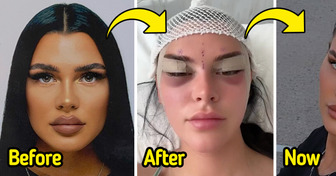 Young Woman’s Journey Through the Viral Fox Eye Surgery Trend