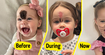 “We Got Stares,” Parents Chose to Remove Their Daughter’s Rare Birthmark to Prevent Teasing