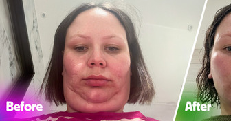 15 People Who Opted for Plastic Surgery and Are Now Obsessed with Their New Look