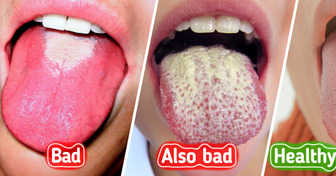 What a White Tongue May Reveal About Your Health — and How to Treat It Naturally