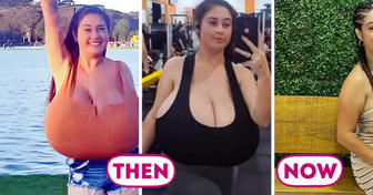 Girl Undergoes Surgery to Reduce 22-Pound Breasts, Revealing the Harsh Reality of Gigantomastia