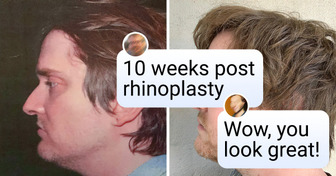 18 People Who Went for Plastic Surgery and Never Looked Back