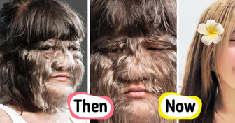 “World’s Hairiest Girl” Reveals Astonishing New Look — Fully Grown and Madly in Love