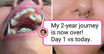 15 People Who Were So Thrilled to Share Their Teeth Progress