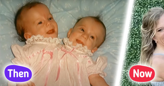 Conjoined Twins Spark Heated Debate After Revealing They Paid Double College Fees but Earn Only One Salary