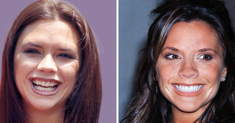 17 Pics That Prove Even Celebrities Aren’t Born With a Perfect Smile