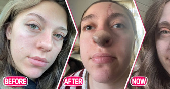 Young Woman Got Mauled by the Family Dog, Causing Hair to Grow on Her Nose