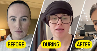 After Years of Cruel Comments, Woman Decided to Undergo Forehead Reduction Surgery