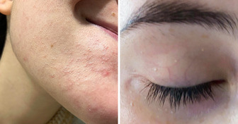 How to Treat Those White Bumps That Keep Popping Up on Your Face
