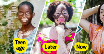 Meet the “Chameleon” Woman Who Turns Her Unique Beauty Into Inspiration