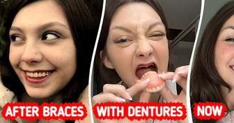 Woman, 32, Who Lost All Teeth at 20, Revealed Her Drastic Dental Surgery Results