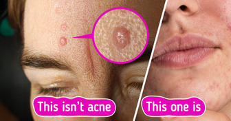 7 Skin Bumps You’re Probably Mistaking for Acne