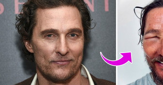 Matthew McConaughey Concerns Fans by Revealing That His Eye Was Completely Swollen Shut