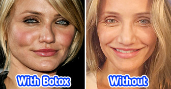 16 Celebrities Who Deeply Regret Their Cosmetic Procedures