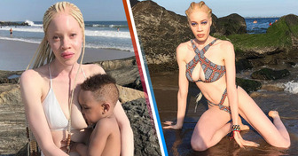 A Woman Faced Mockery and Skepticism Due to Her Albinism, But Now She Is Rocking the World’s Catwalks