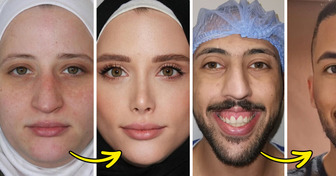 People Can’t Believe These Plastic Surgery Transformations Using the Golden Ratio