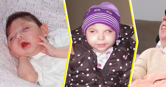 She Was Born Without a Brain and Given Only 4 Years to Live — but She Turned 20 Against All Odds