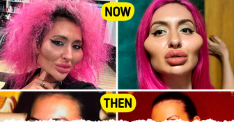 See “Biggest Cheeks in the World” Star’s Face Before Cosmetic Procedures