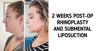 15+ Girls Who Wanted to Zhoosh Up Their Looks With Plastic Surgery and Their Results Are Jaw-Dropping