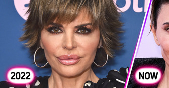 «What Did She Do to Her Face?», Lisa Rinna’s Latest Appearance Sparks Controversy