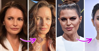 5 Celebrities Who Regretted Their Facial Fillers and Had Them Removed