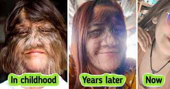 The World’s Hairiest Girl Is Now Grown Up and Happily Married. Prepare To Be Amazed by Her New Look