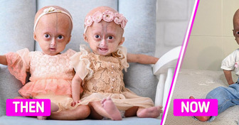Meet Twins with the Rare Benjamin Button Syndrome, Who Became Symbols of Resilience