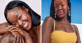 “I’m Allowed to Be Beautiful,” a Model With a Rare Skin Disorder Challenges the Beauty Industry