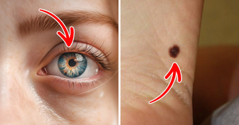 6 Early Signs of Melanoma You Need to Check for Today