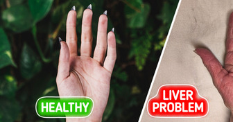 6 Unusual Warning Signs of Liver Issues You Shouldn’t Ignore