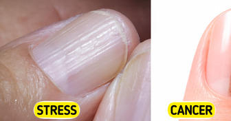 5 Serious Health Issues Your Nails Might Be Warning You About