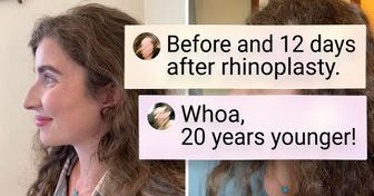 16 People Who Mustered the Courage to Get Plastic Surgery and Now Look Absolutely Stunning