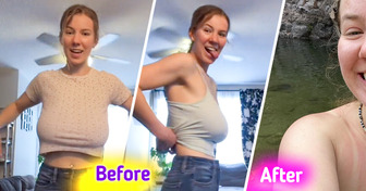 Woman Reveals Her Breast Reduction Journey, Leaving Everyone Stunned by the Results