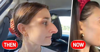 After Years of Dreaming She Finally Got a Nose Job and the Results Are Unbelievable